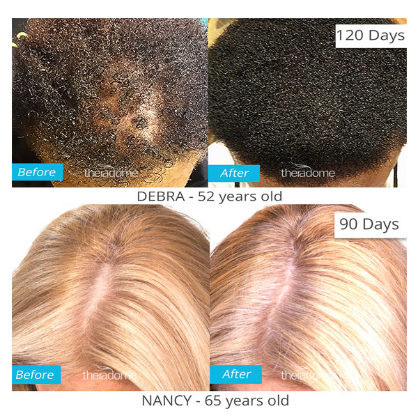 Theradome-before-after